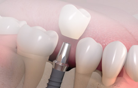 Dental Implants