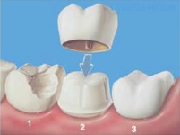 Crowns diagram