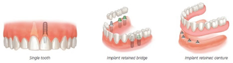 Fixed detachable bridge implants diagram