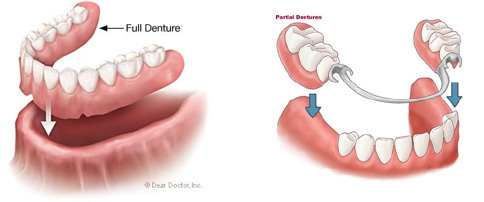 Full and partial dentures diagram