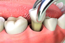 Extractions diagram