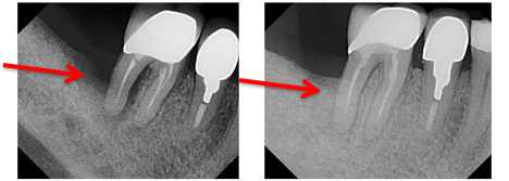 Periodontal LANAP diagram