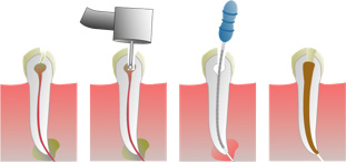 Root canals diagram