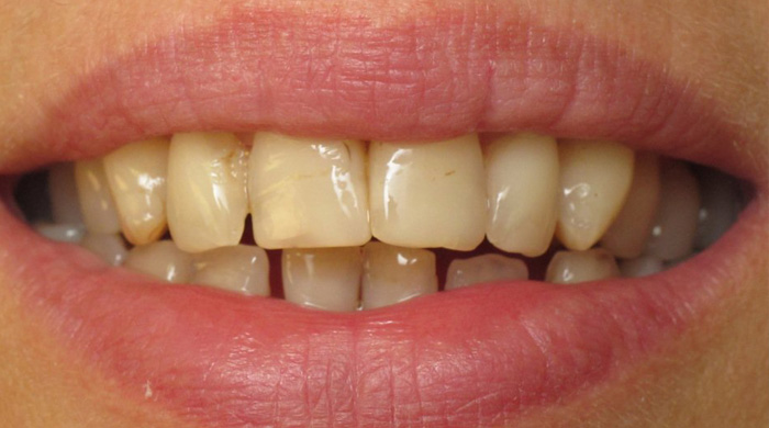 1. Stained or Discolored Teeth