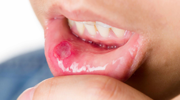 7. Mouth Sores