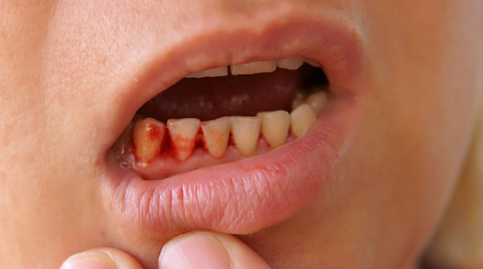 8. Bleeding or Sore Gums